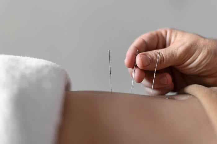 Dry needling being performed on a patient's neck and upper trapezius at Axis Health and Wellness in Centennial CO